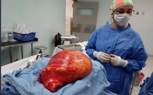 Médicos del IMSS realizan cirugía para retirar tumor de 17 kg