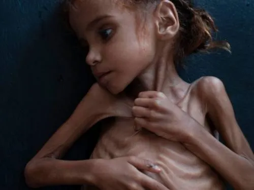 Muere Amal Hussain, la niña que mostró la hambruna en Yemen