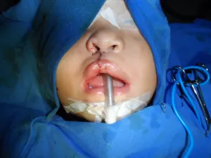 Realizarán en Puebla valoraciones para operar labio/palar hendido