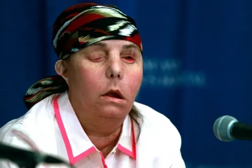 Realizan segundo trasplante de cara a una mujer en EEUU