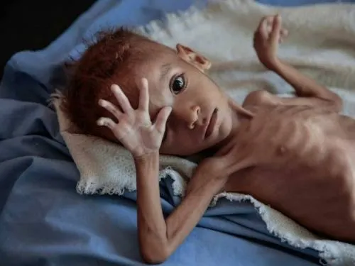 En Yemen han muerto de hambre 85 mil niños durante la guerra, estima ONG
