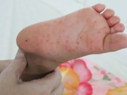 ¡Confirmado! Hay brote de virus Coxsackie en guardería de Querétaro