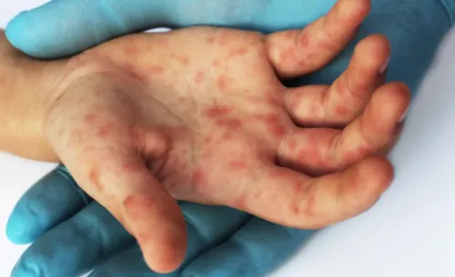 Ssa emite recomendaciones a viajeros por casos de sarampión en EEUU