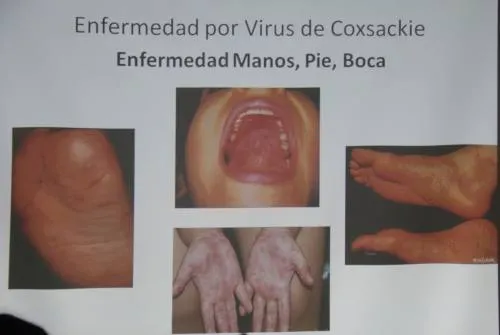 El virus de Coxsackie no debe generar alarma en la población