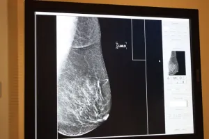 Explica especialista del IMSS Puebla medidas preventivas contra cáncer de mama