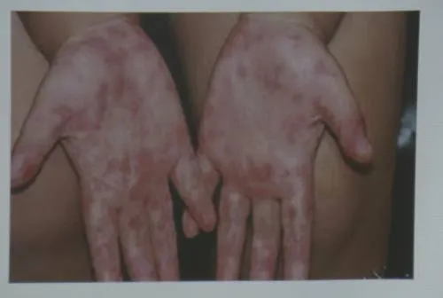 No hay riesgo de epidemia del virus de Coxsackie en Puebla