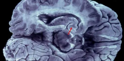 Un robot vence a médicos en el diagnóstico de tumores cerebrales