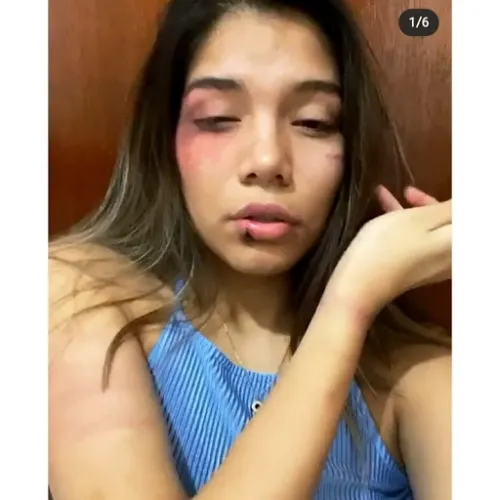 UVM pide justicia para Montserrat, la joven golpeada por un estudiante de la UDLAP