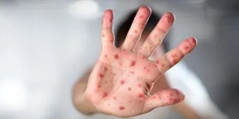 OMS pide aumentar vigilancia ante propagación de la viruela del mono