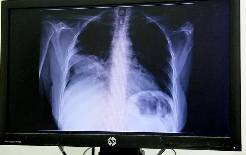 issste-cancer-de-pulmon