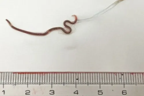 ¡Qué asco! Gusano crece hasta 4 centímetros en la garganta de una mujer luego de comer sashimi
