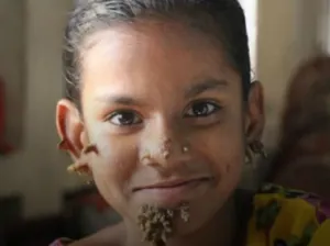 Video: Niña en Bangladesh, diagnosticada con el mal del ‘hombre árbol’