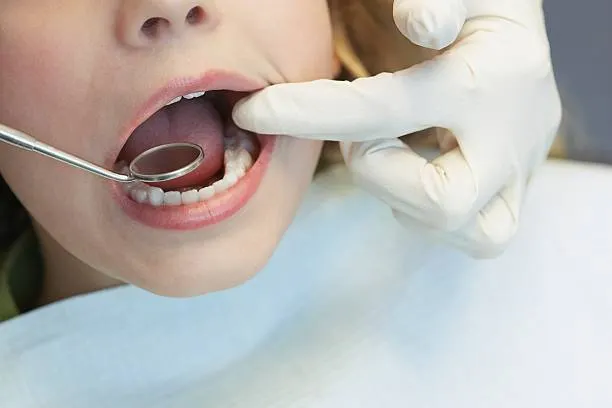 Puebla, segundo lugar nacional en caries infantil: 80% de los estudiantes de primaria la padecen
