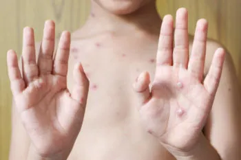 Puebla sin casos de viruela símica en escuelas, confirma Secretaría de Salud