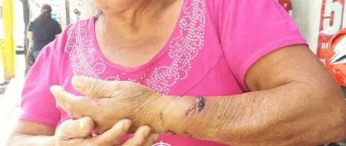 Perro ataca a mujer de la tercera edad en Huauchinango