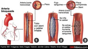 Colocan un “Stent” a Andrés Manuel López Obrador