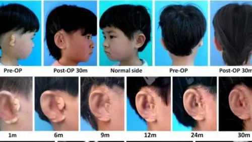 Cinco niños en China reciben el primer trasplante de oído fabricado con sus propias células