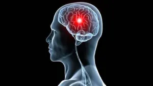 ¿Cuáles son los síntomas de un infarto cerebral?