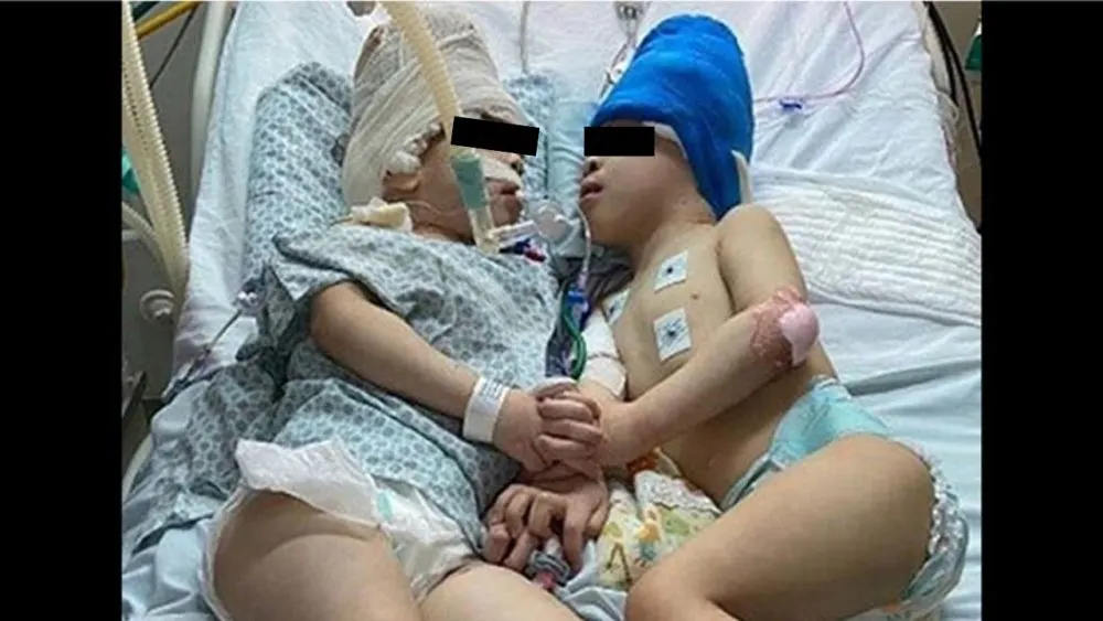 Gemelos unidos por la cabeza fueron separados con cirugía de 23 horas en Brasil