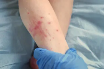 Por dengue en Puebla, nueve personas fueron hospitalizadas