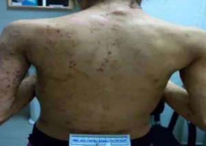 Joven esclavizada tiene 400 cicatrices en todo el cuerpo