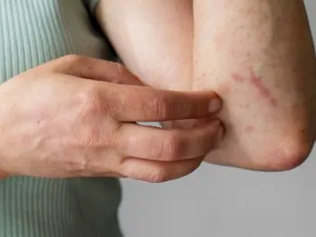Puebla, sin defunciones por dengue en últimas 24 horas