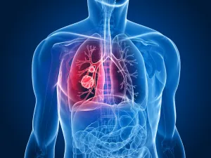 ¿Por qué el cáncer de pulmón es el más mortífero en el mundo?