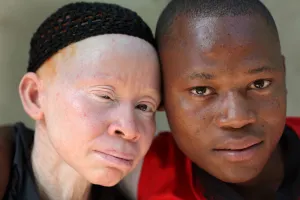 Carnicería humana: el drama de ser albino en África
