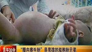 Bebé tenía a su hermano gemelo dentro del estómago