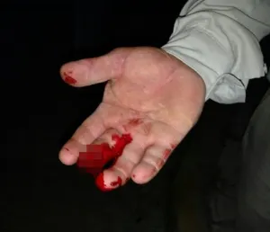Sujeto le arranca el dedo a hombre a quien pretendìa robar