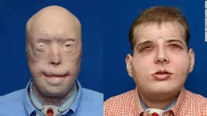 Este hombre recibió el trasplante de cara más extenso de la historia