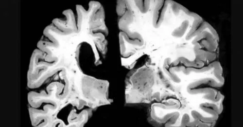 Estudio relaciona el Alzheimer con sobrepeso y obesidad a temprana edad