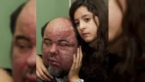 Buscan transplantar rostro, orejas, huesos y pelo a un hombre en España