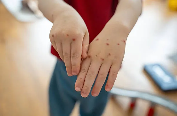 Suspenden clases en escuelas de Puebla por brote del virus Coxsackie