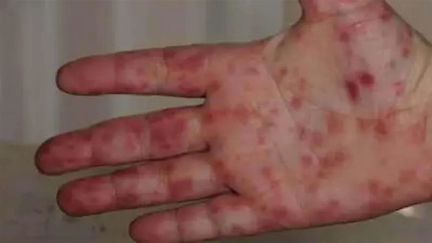 ¡Ahora llega la gripe del tomate!, un virus contagioso de la India