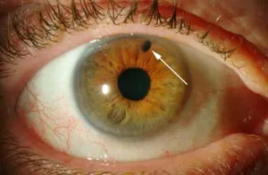 Desarrollan en Suiza chip ultraflexible capaz de controlar el glaucoma