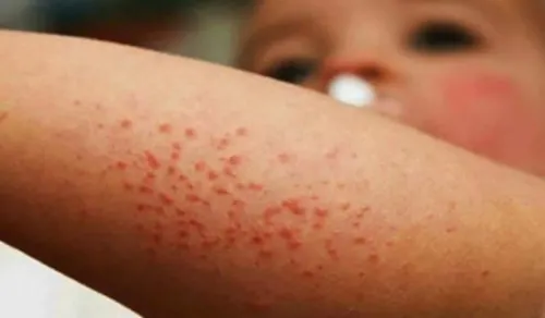 Sarampión: 6 casos cada día; epidemia en EU