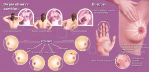 ¿Cuáles son los síntomas del cáncer de mama?