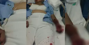 Hombre ataca a enfermera y huye pero ella le clava tijeras