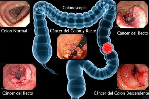 Cáncer de colon, el cuarto más frecuente en México; causa 700 mil muertes al año