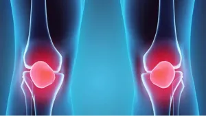 Imprimen cartílagos para enfermos de artritis
