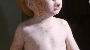 La reina de todas las enfermedades infecciosas