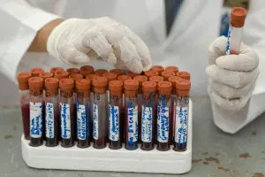 VIH, eliminado del genoma humano