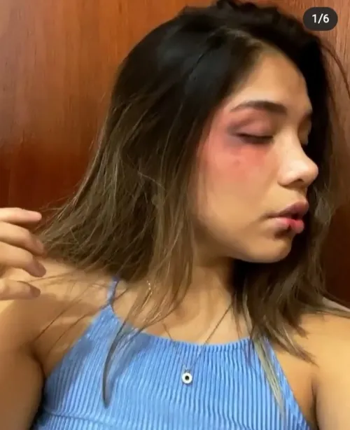 En redes sociales, joven poblana alza la voz tras ser golpeada