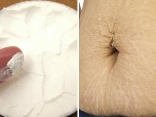 ¿Tienes estrías? Mira este remedio casero para eliminarlas