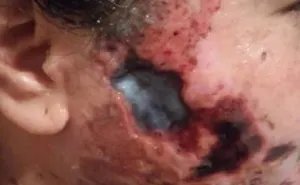 Sujeto le arroja ácido en la cara  a su expareja por negarse a regresar con él