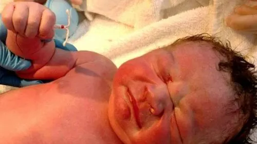 Nace bebé sosteniendo en su mano el DIU de su madre