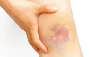 ¿Cómo detectar a tiempo la leucemia?