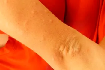 Repuntan casos de dengue en municipios de Izúcar y Tehuacán: Salud