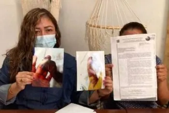 Apoyarán caso de bebé al que le amputaron brazo por negligencia